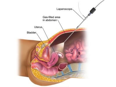 Laparoscopic and minimal access urology